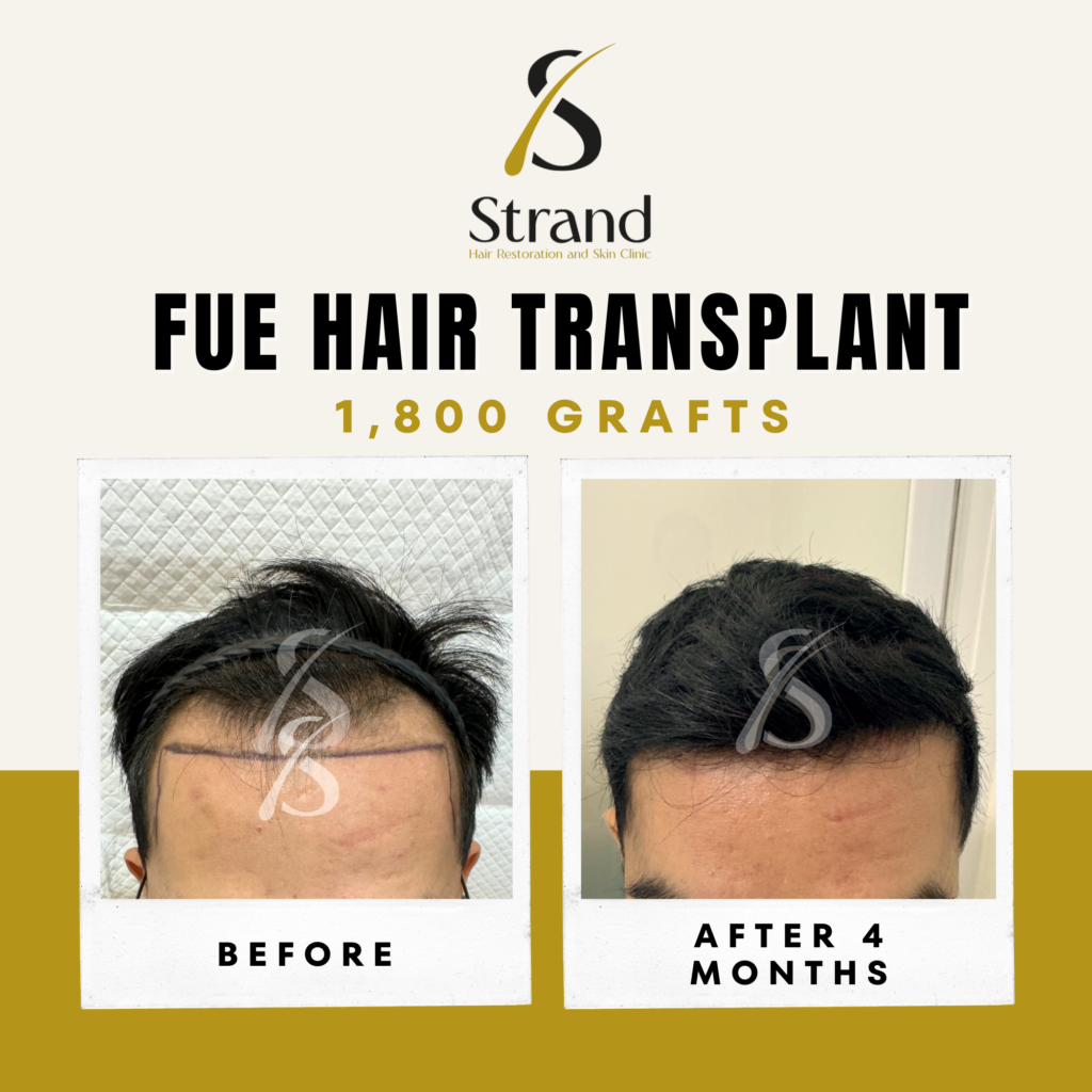 strand before and after (1)